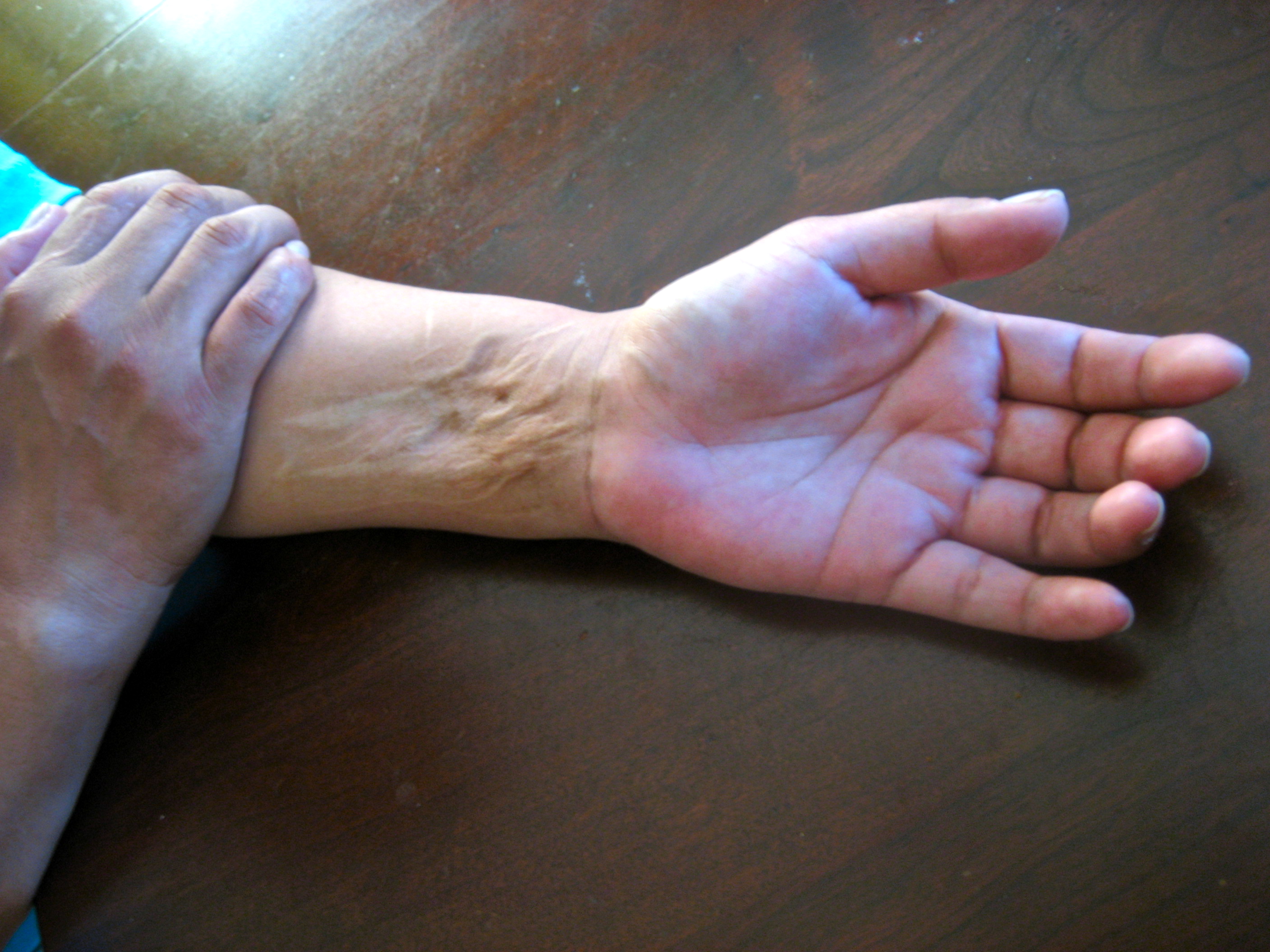 Wrist Scars